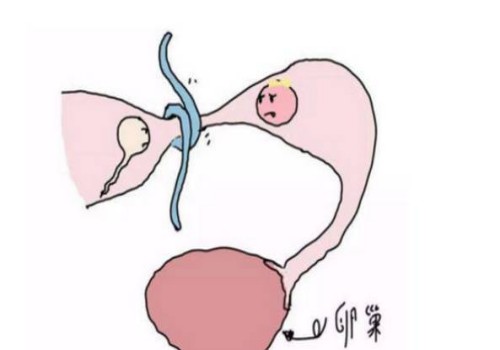 降调能抑制巧囊吗，巧囊降调再移植有什么作用？